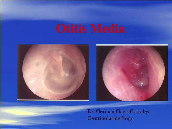 otitis media