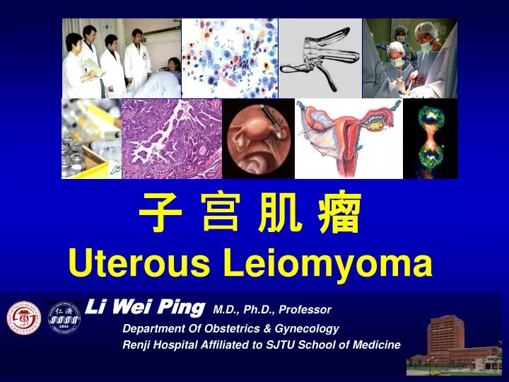 uterous leiomyoma