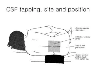 CSF tapping, site and position