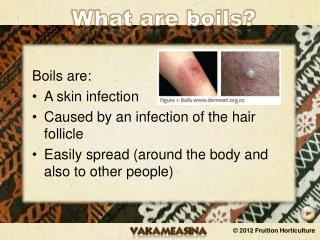 What are boils?