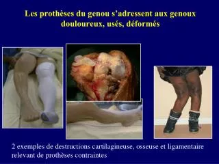 Les prothèses du genou s’adressent aux genoux douloureux, usés, déformés