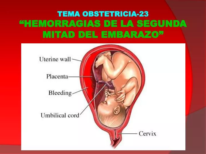 tema obstetricia 23 hemorragias de la segunda mitad del embarazo