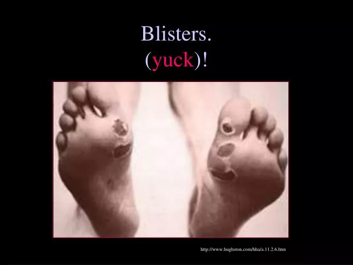 blisters yuck