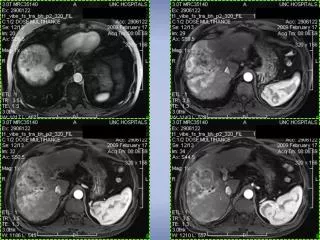 Hepatocellular Carcinoma from the ACC to Med E