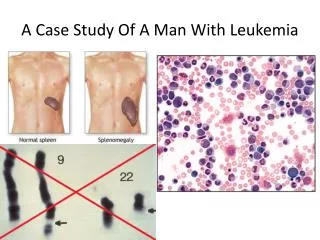 A Case Study Of A Man With Leukemia