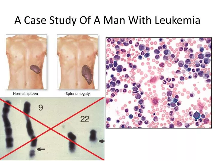 a case study of a man with leukemia
