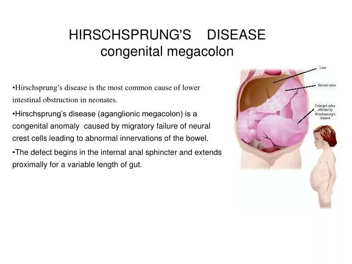 hirschsprung s disease congenital megacolon