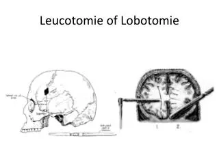 Leucotomie of Lobotomie