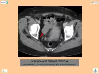 CARCINOMA DE TROMPA DERECHA