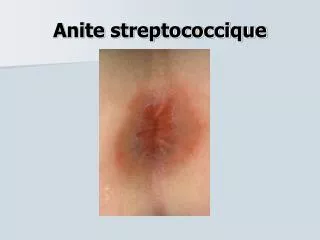 Anite streptococcique