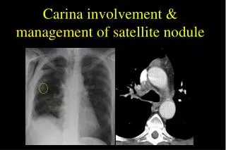 Carina involvement &amp; management of satellite nodule