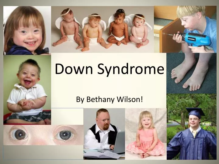 down syndrome