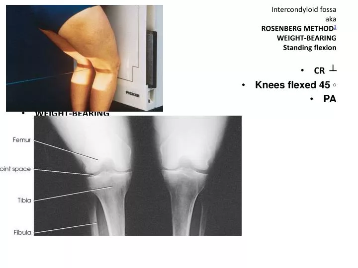 intercondyloid fossa aka rosenberg method 1 weight bearing standing flexion