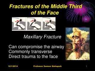 Fractures of the Middle Third of the Face