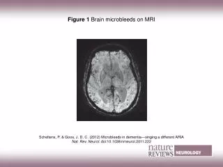 Figure 1 Brain microbleeds on MRI