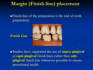 Margin (Finish line) placement Finish line of the preparation is the end of tooth preparation.