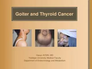 Goiter and Thyroid Cancer