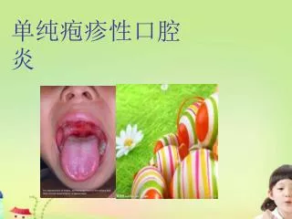 单纯疱疹性口腔炎