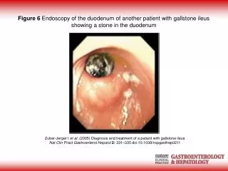 Zuber-Jerger I et al . (2005) Diagnosis and treatment of a patient with gallstone ileus