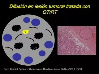 Difusión en lesión tumoral tratada con QT/RT