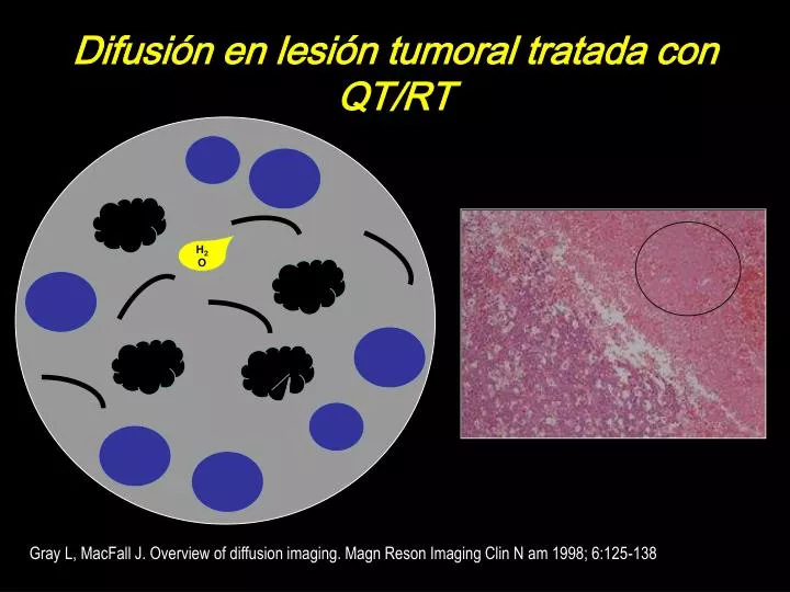 difusi n en lesi n tumoral tratada con qt rt