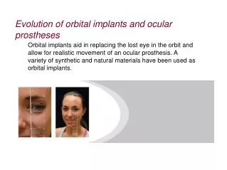 Evolution of orbital implants and ocular prostheses