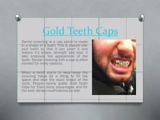 Gold Teeth Crowning