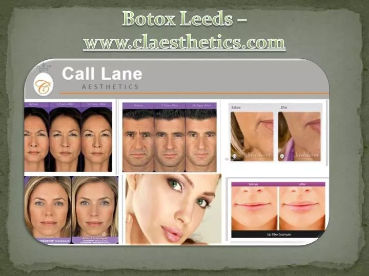 botox leeds www claesthetics com