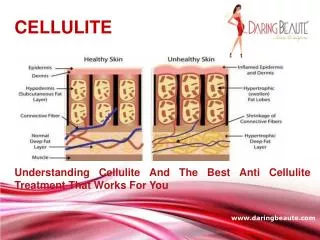 Understanding Cellulite And The Best Cellulite Treatment