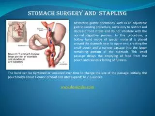 Stomach Surgeon, Stomach Stapling Specialist in Pune