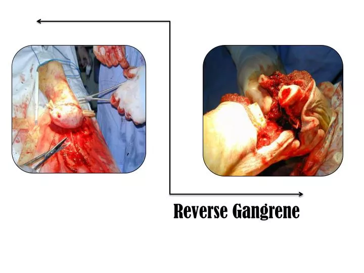 reverse gangrene