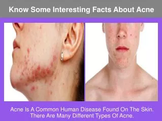 Know Some Interesting Facts About Acne