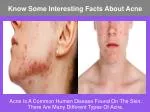 Know Some Interesting Facts About Acne