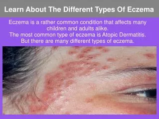 Learn About The Different Types Of Eczema
