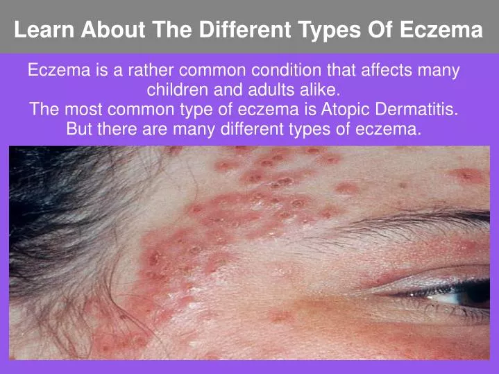 learn about the different types of eczema